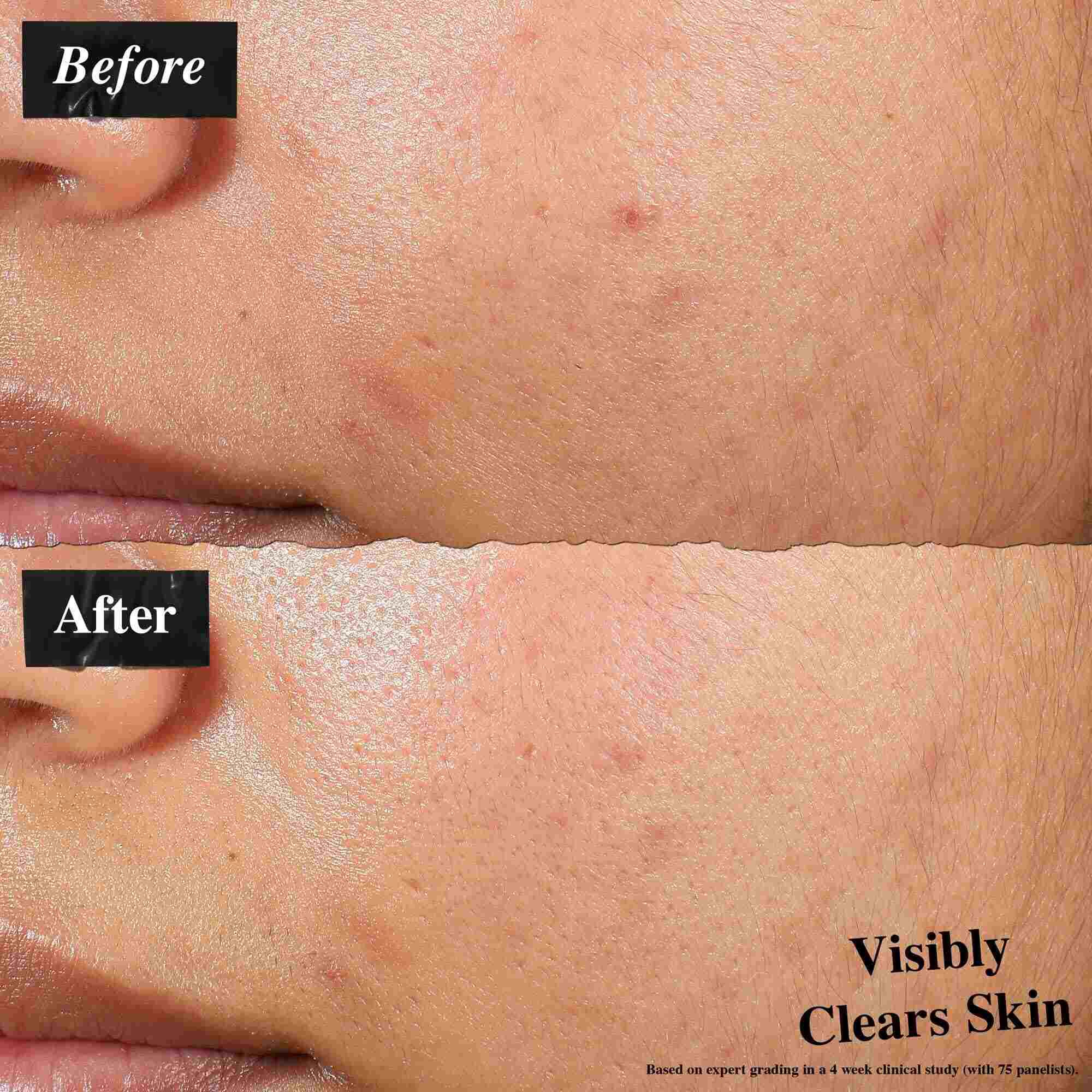 Porovnanie pred a po ukazujuce pleť ošetrenu Expertly Clear Blemish-Treating & Preventing Lotion. Obrazok „pred“ ukazuje nedokonalosti a nerovnomernu texturu pleti, zatiaľ čo obrazok „po“ ukazuje viditeľne čistejšiu pleť.