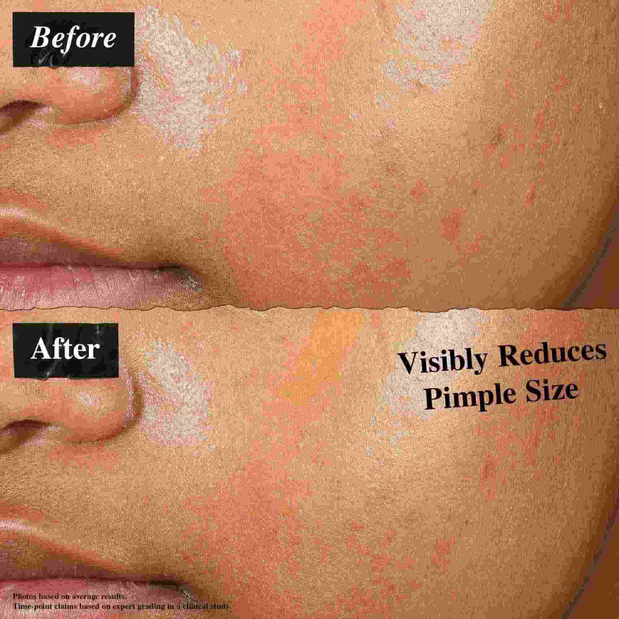 Porovnanie pred a po ukazujuce pleť ošetrenu Truly-Targeted Blemish-Clearing Solution. Obrazok "pred" ukazuje viditeľne vyražky, zatiaľ čo obrazok "po" ukazuje zmenšenu veľkosť vyražok.