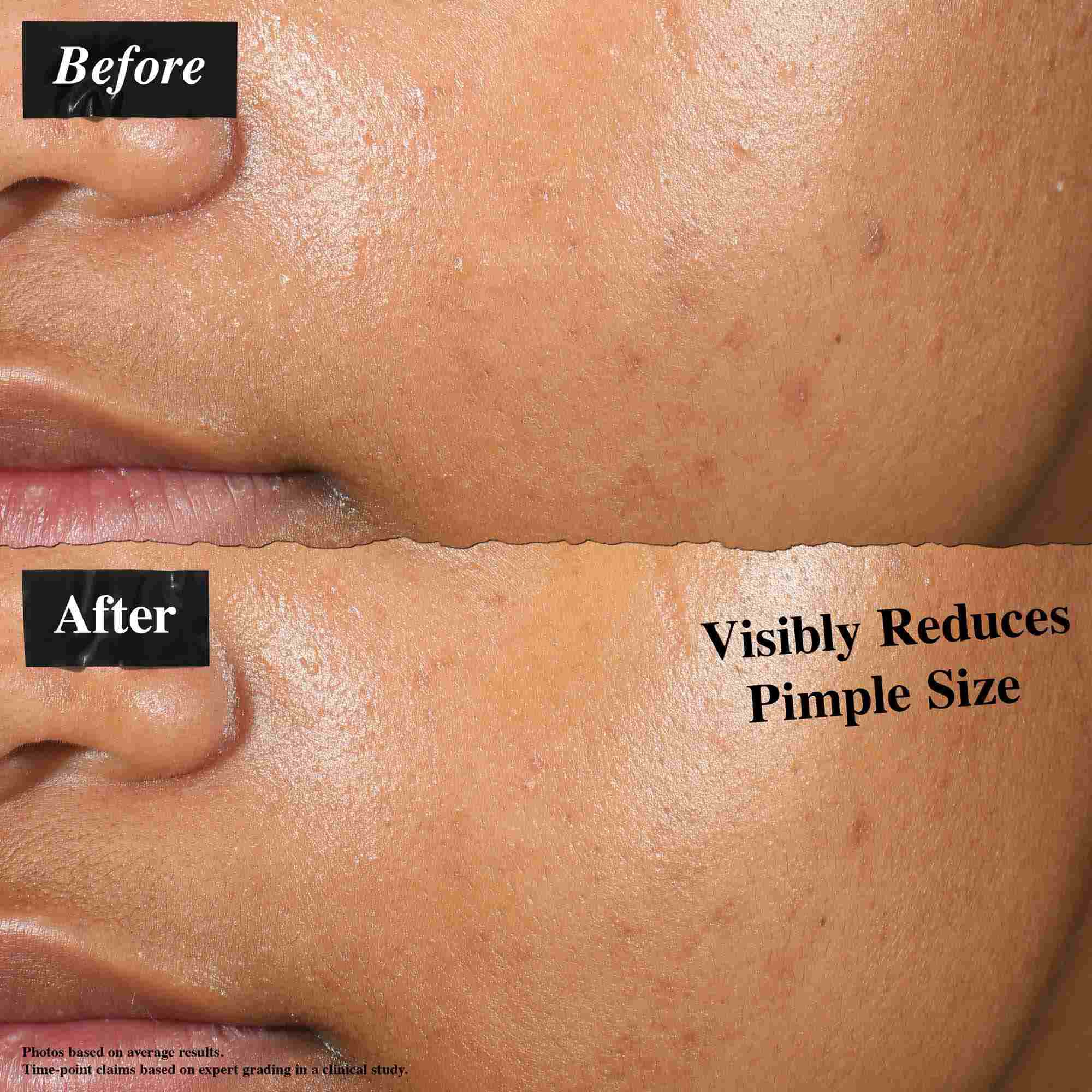 Porovnanie pred a po ukazujuce pleť ošetrenu Truly-Targeted Blemish-Clearing Solution. Obrazok "pred" ukazuje viditeľne vyražky, zatiaľ čo obrazok "po" ukazuje zmenšenu veľkosť vyražok.