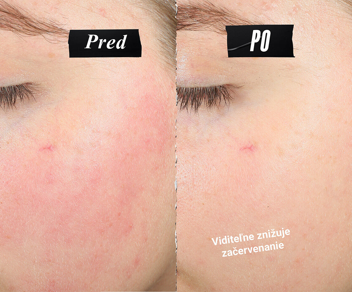 Porovnanie ukazujuce zmiernenie začervenania pleti. Text znie: Viditeľne redukuje začervenanie.