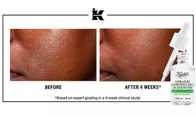 Alt text: A side-by-side comparison of skin before and after 4 weeks of using Kiehl's Ultra Pure High-Potency Serum with Niacinamide. The "before" image shows uneven texture, while the "after" image reveals smoother skin. A dropper bottle of the serum is shown in the corner.