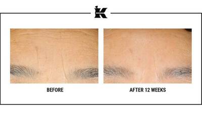 Vysledky po použiti Retinol Skin-Renewing Daily Micro-Dose Serum