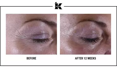 Alt text: "Side-by-side comparison of a person's eye area showing visible skin improvement after 12 weeks of treatment, with reduced wrinkles and smoother texture."